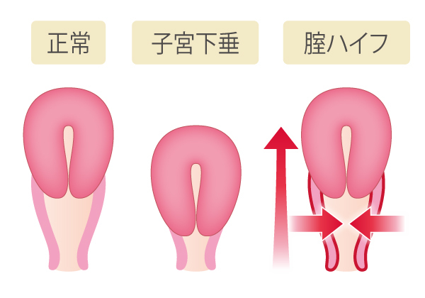 腟ハイフは効果がある？医学的根拠と施術内容を解説