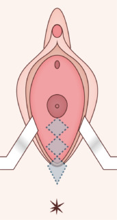 ダイアモンドシェイプ腟形成術1 ダイアモンドシェイプ腟形成術1