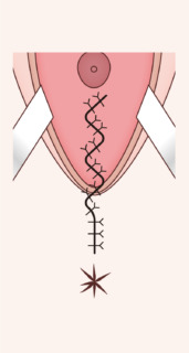 ダイアモンドシェイプ腟形成術1 ダイアモンドシェイプ腟形成術1
