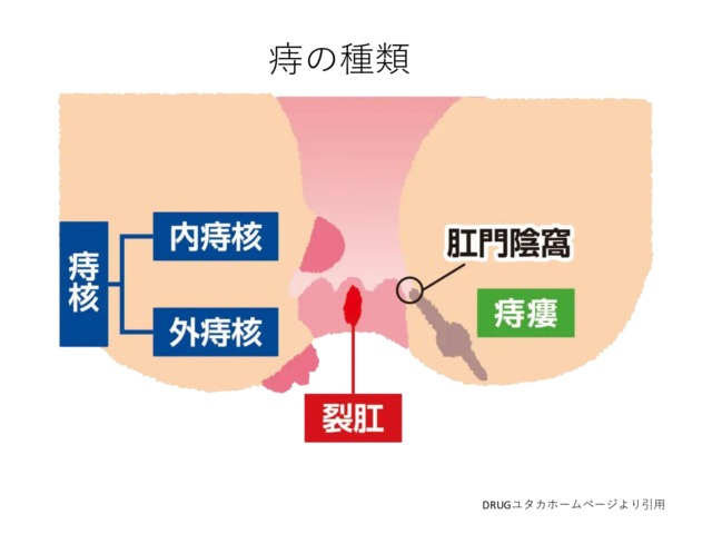 痔の種類 痔の種類