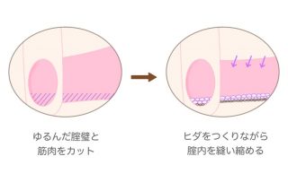 腟縮小手術の詳細(腟内の断面図で見た場合) 腟縮小手術の詳細(腟内の断面図で見た場合)