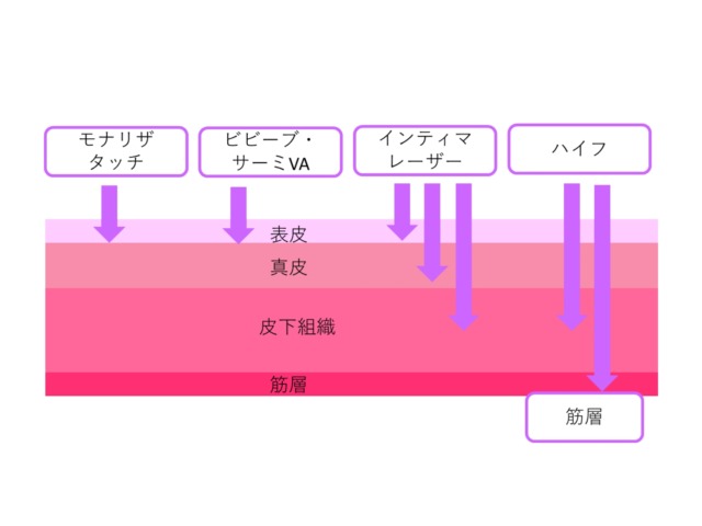 モナリザタッチとyoniHIFUの違い モナリザタッチとyoniHIFUの違い