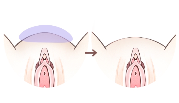 恥骨上の膨らみが気になる