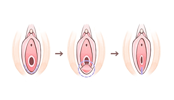 腟口の腟縮小