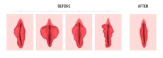 小陰唇縮小術のBEFORE AFTER