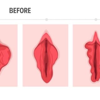小陰唇縮小術のBEFORE AFTER