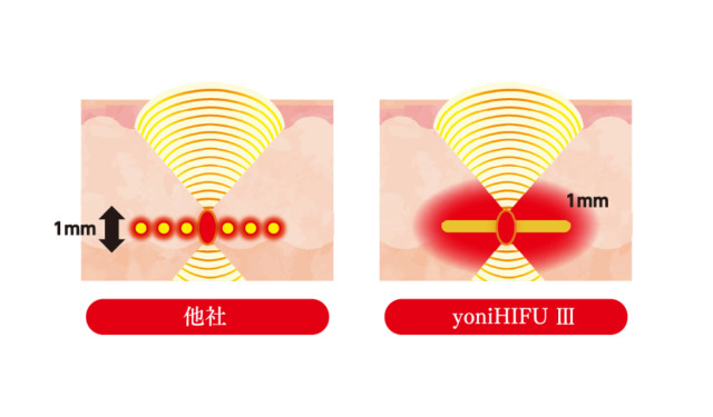 yoniHIFU III_02 (1)