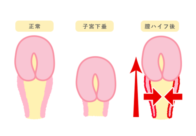 腟圧の平均値は20mmHG！】丹羽咲江医師に腟圧を測定していただきました | 腟ペディア（チツペディア）